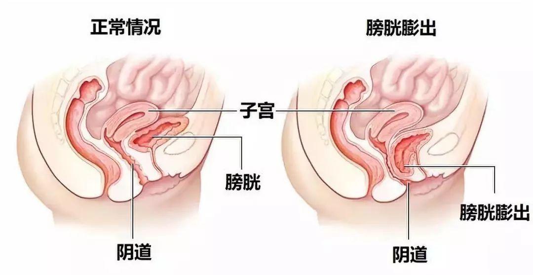 产后两个月肚子恢复状况详解与图解