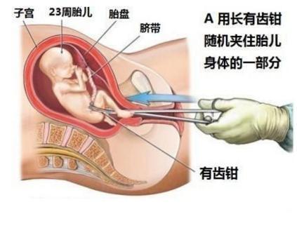 四个月引产，危险与否的全面解析