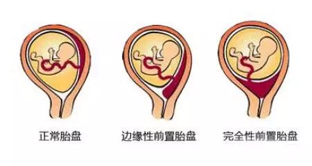 怀孕五个月胎盘低置怎么办？全面解析与应对建议